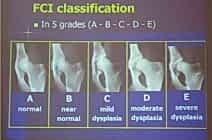 Дисплазия Тазобедренного сустава